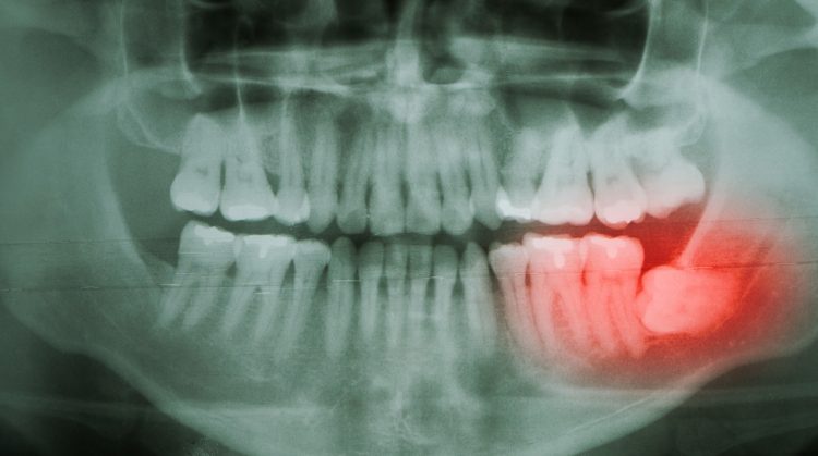 Dental X-ray showing impacted lower right wisdom tooth highlighted in red at Downtown Plaza Dental in Sacramento, CA.