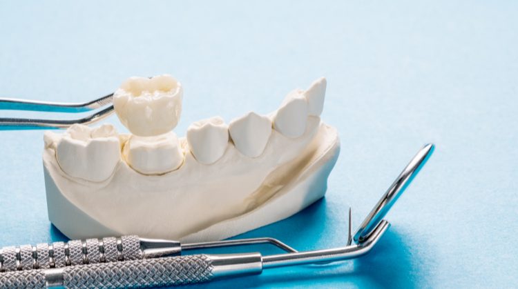Dental crown model with tools at Downtown Plaza Dental, Sacramento, CA.