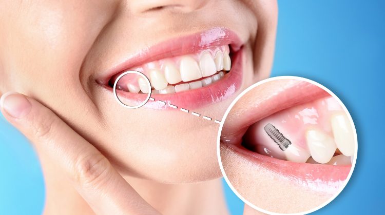 Close-up of a smiling woman with a dental implant illustration, highlighting tooth restoration by Downtown Plaza Dental in Sacramento, CA.