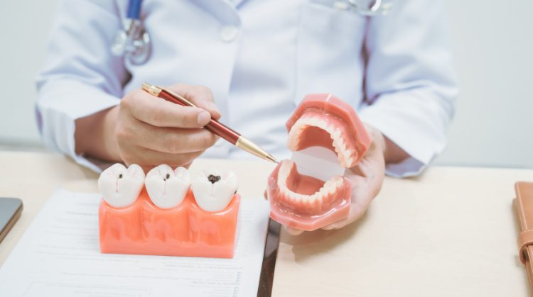 Dentist at Downtown Plaza Dental in Sacramento, CA explaining cavity prevention and treatment using tooth and jaw models.